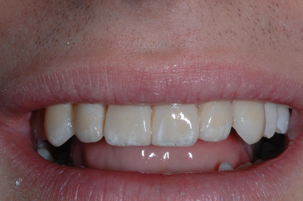 Faccette, veneers