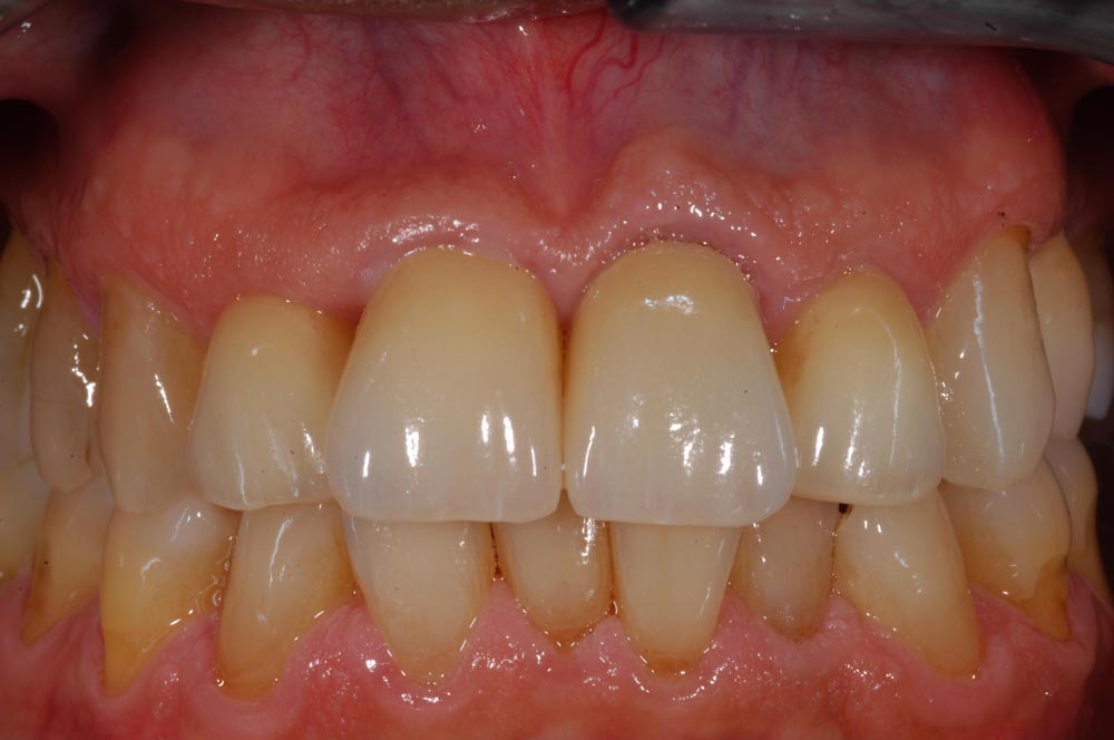 Faccette, veneers