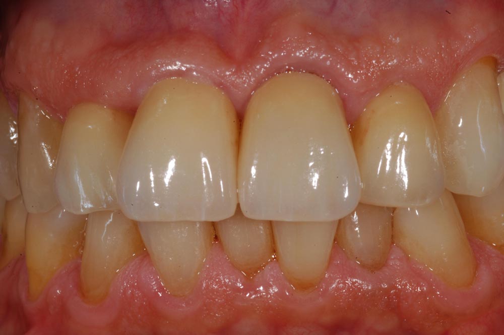 Faccette, veneers