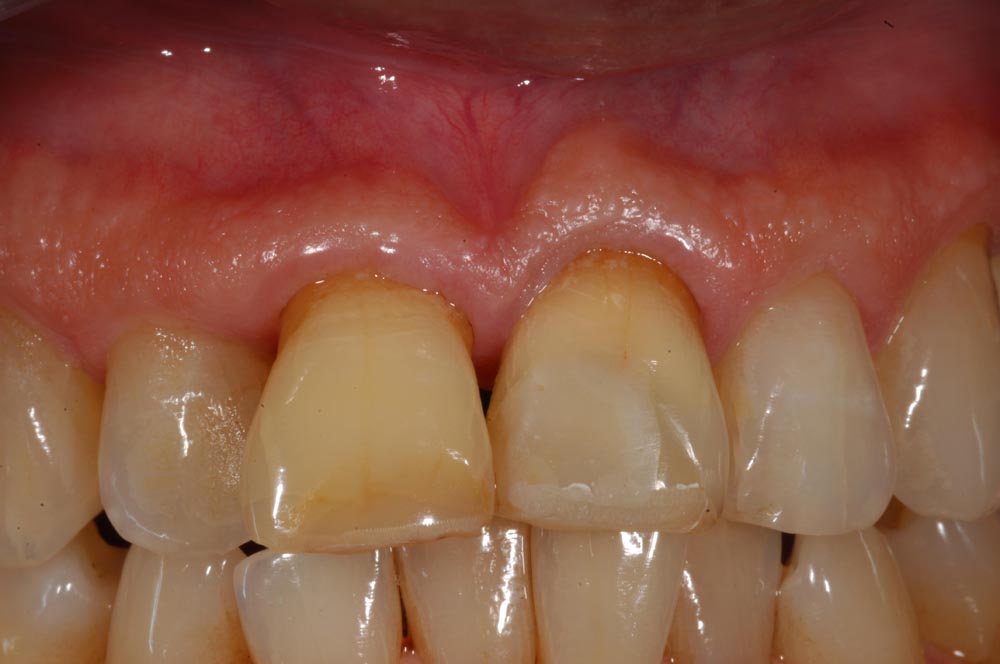 Faccette, veneers