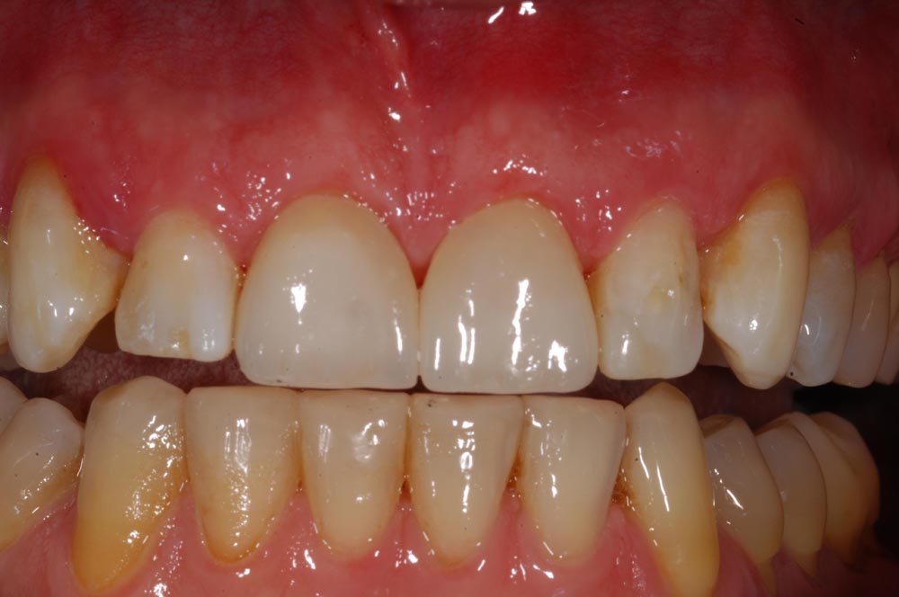 Faccette, veneers, finale