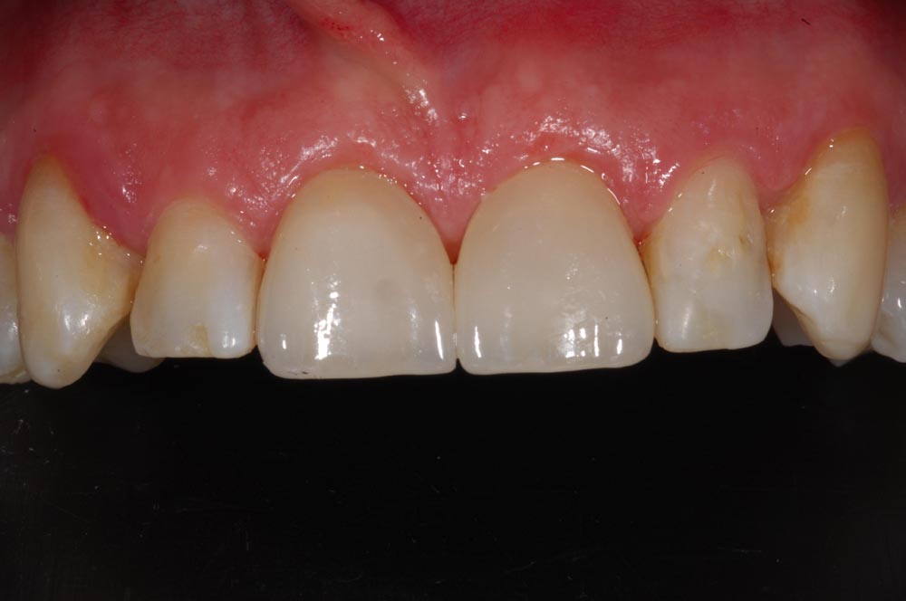 Faccette, veneers, finale