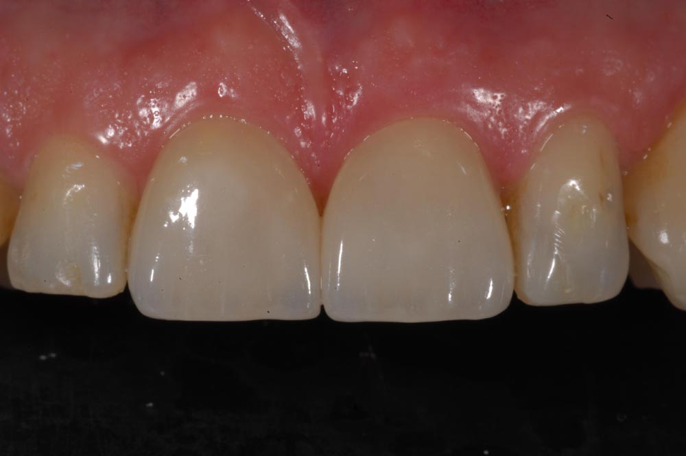 Faccette, veneers, finale