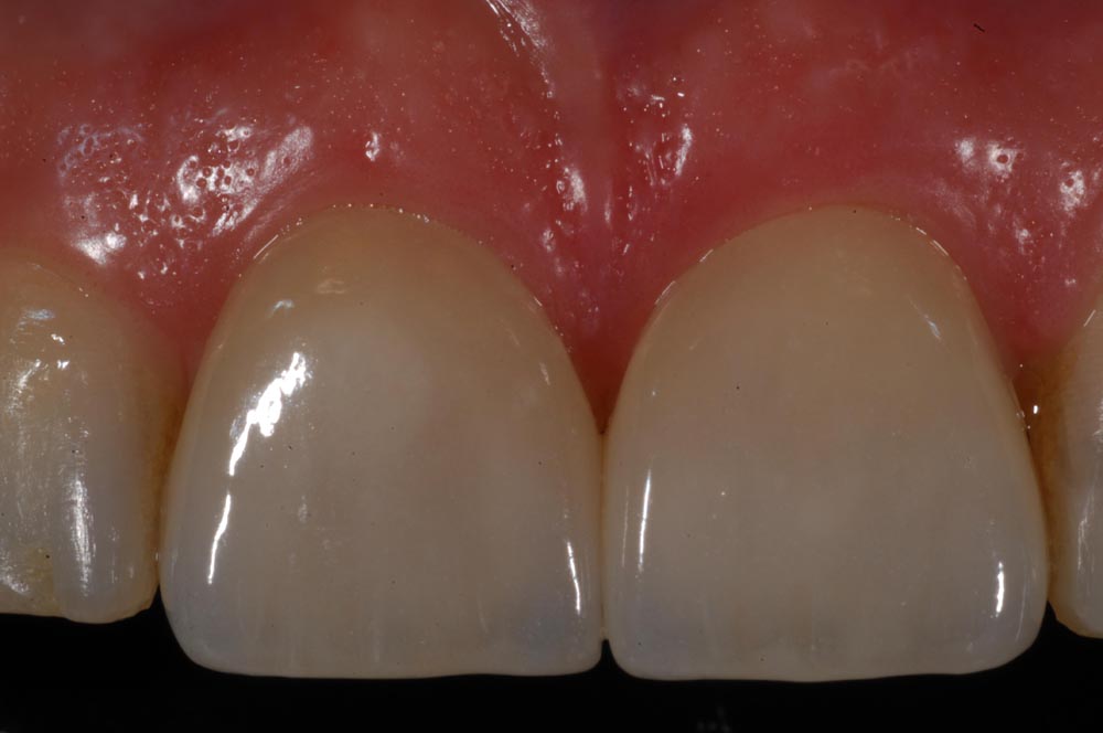 Faccette, veneers, finale