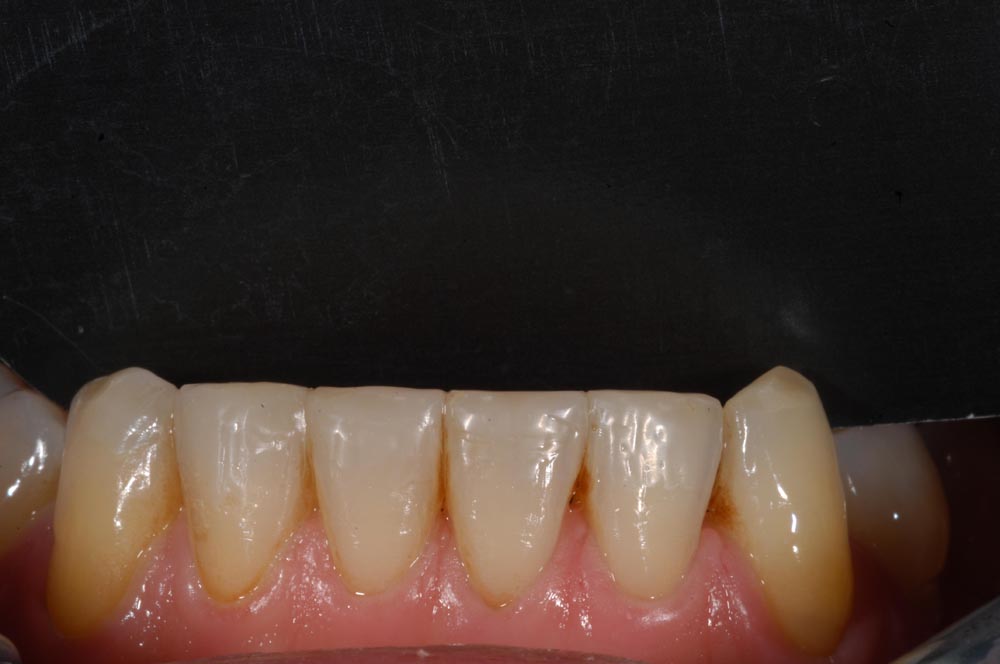Faccette, veneers, inferiore