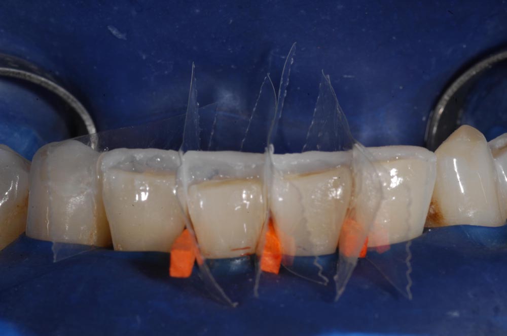 Faccette, veneers, inferiore