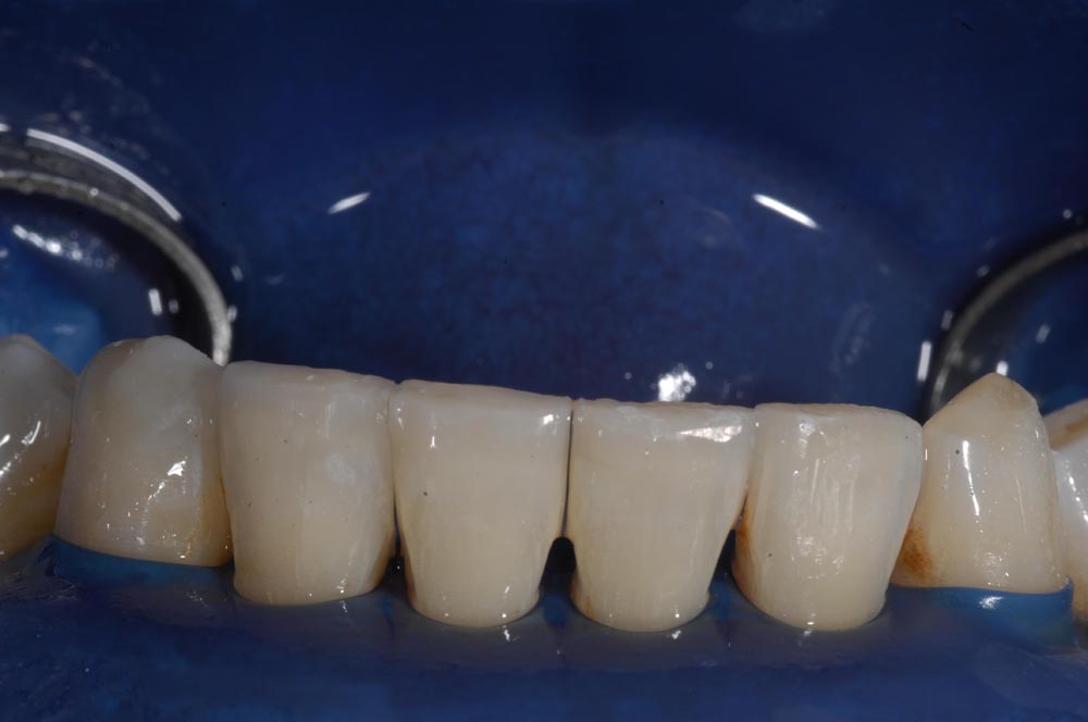 Faccette, veneers, inferiore