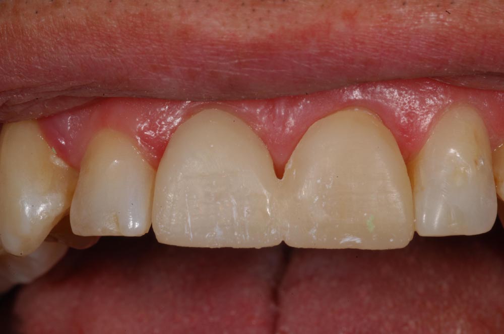 Faccette, veneers, mokeup