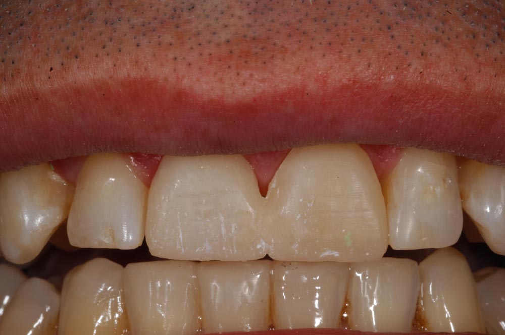 Faccette, veneers, mokeup