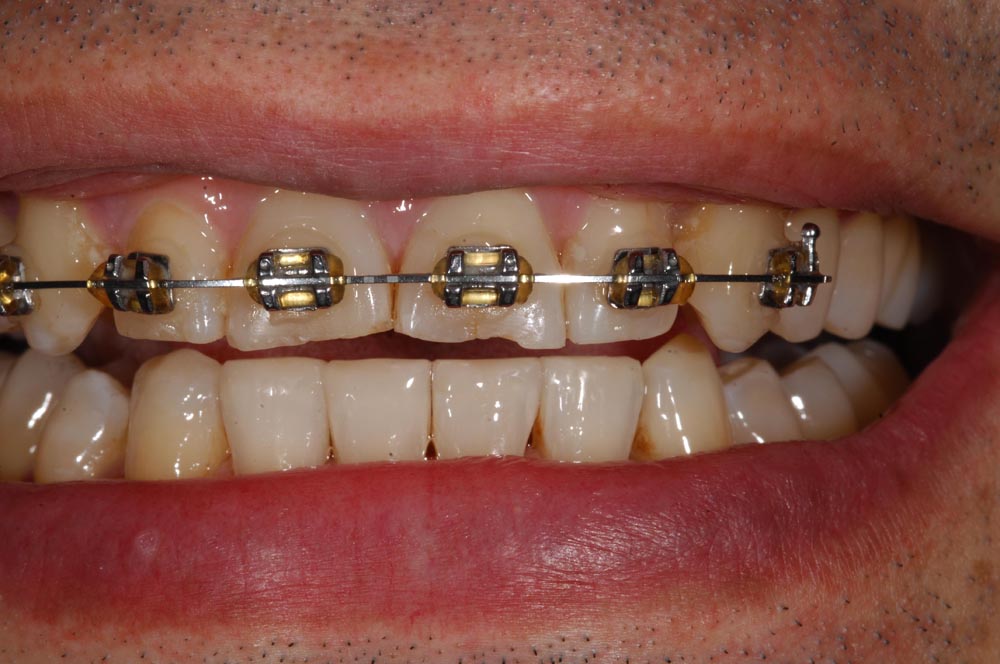 Faccette, veneers, ortodonzia