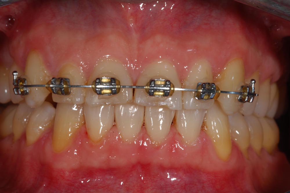 Faccette, veneers, ortodonzia